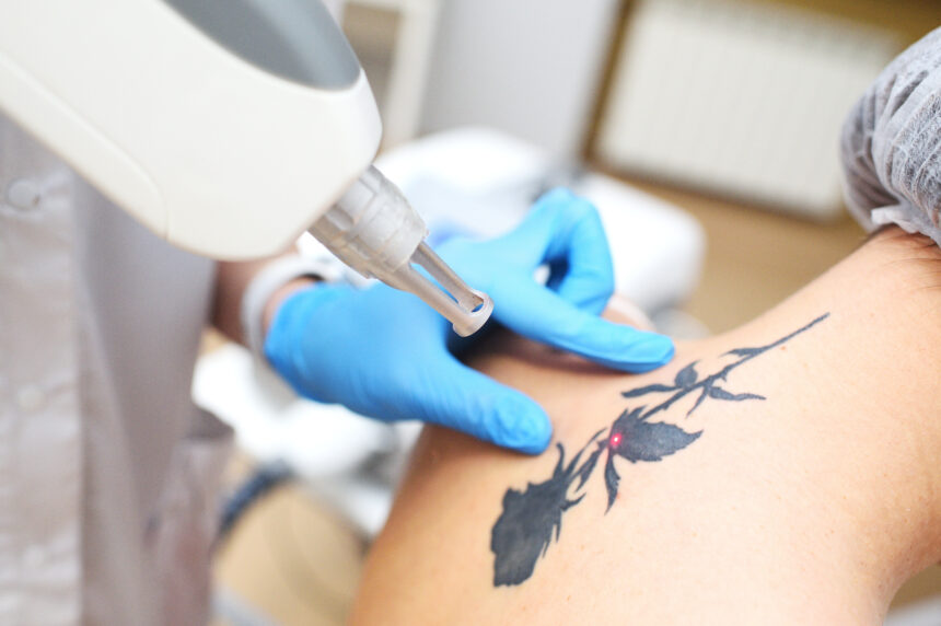 Eliminare tatuaj cu laser